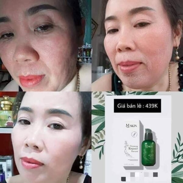 TRONG KHI SỬ DỤNG SERUM THAY DA NHÂN SÂM MQSKIN DA SẼ CÓ NHỮNG BIỂU HI