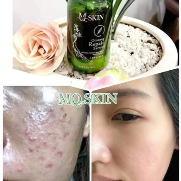 Phản Hồi Serum Thay Da Nhân Sâm Mqskin. Bạn nên xem trước khi mua!!