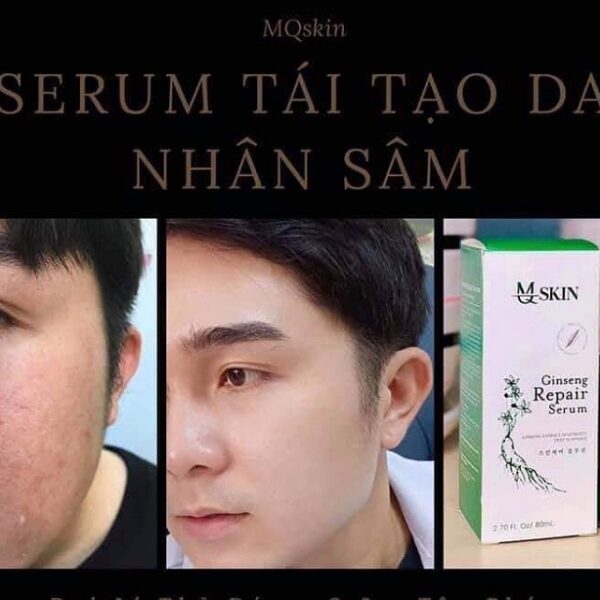 Lấy Sỉ Serum Thay Da Nhân Sâm MQskin ở đâu giá rẻ nhất? Bạn nên biết!